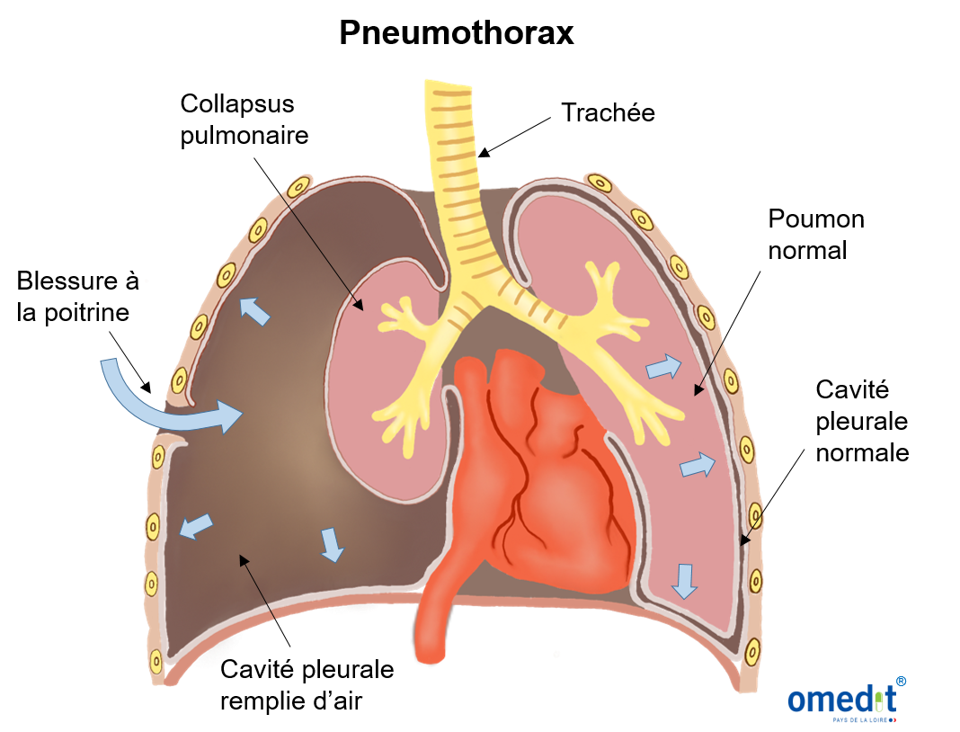 Pneumothorax